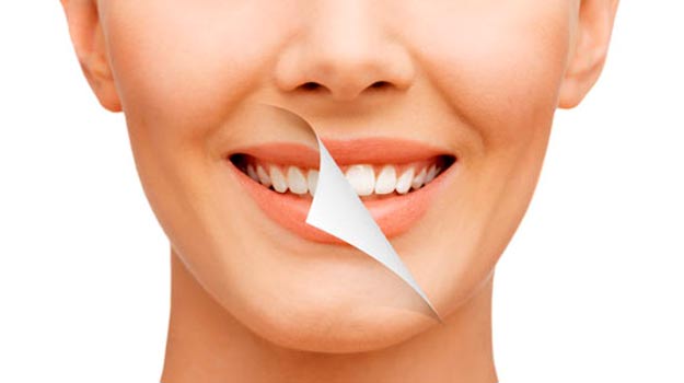 Before and After Teeth Whitening